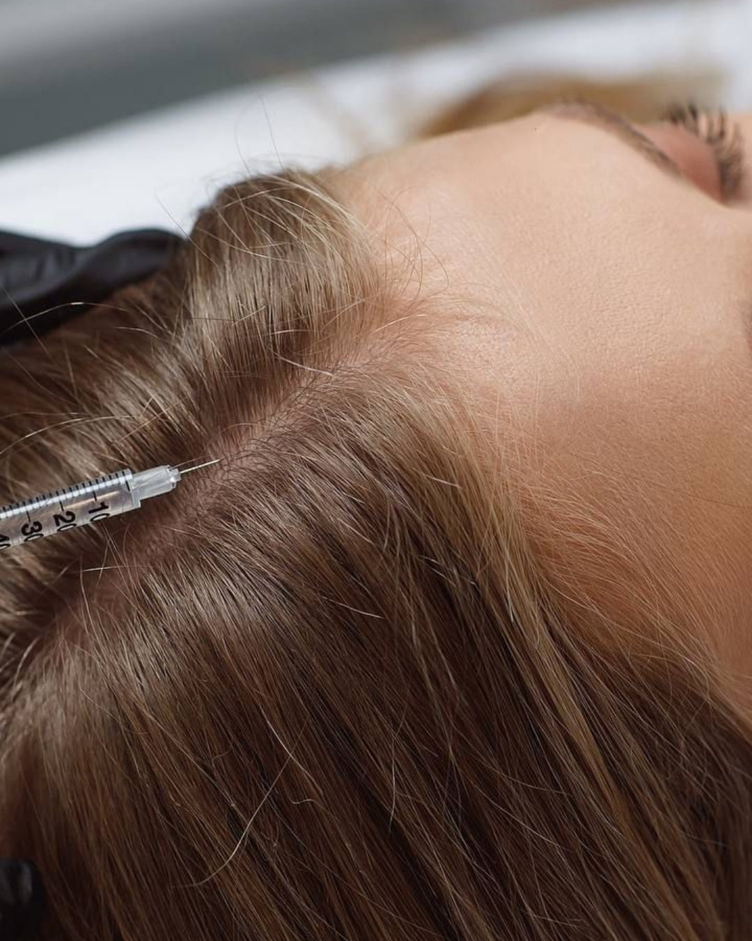 Tratamiento de Mesoterapia Capilar en Madrid