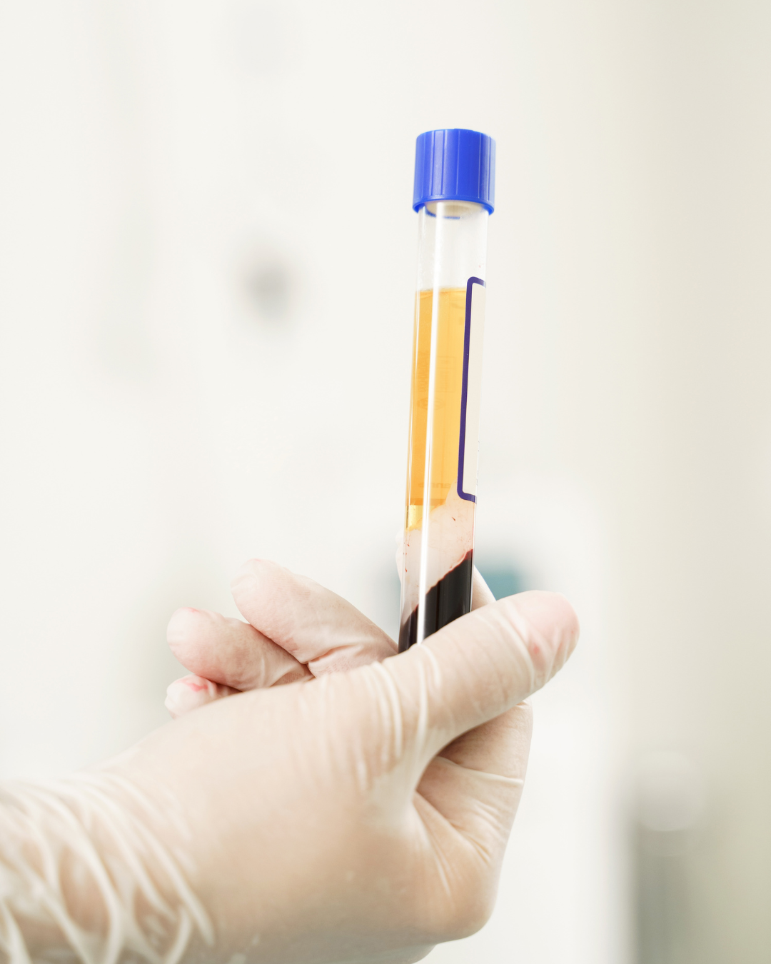 Plasma Rico en Plaquetas: el ciclo ideal para tu rejuvenecimiento facial.