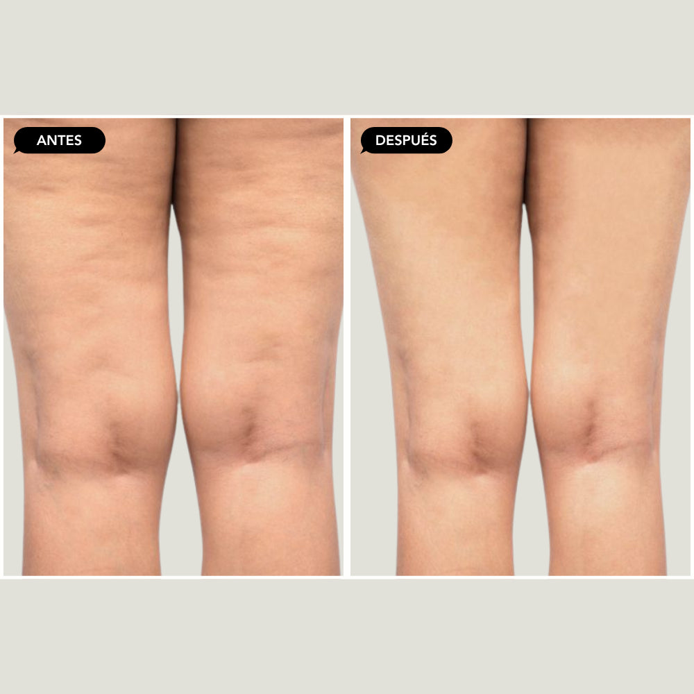 Iron contour - INDIBA