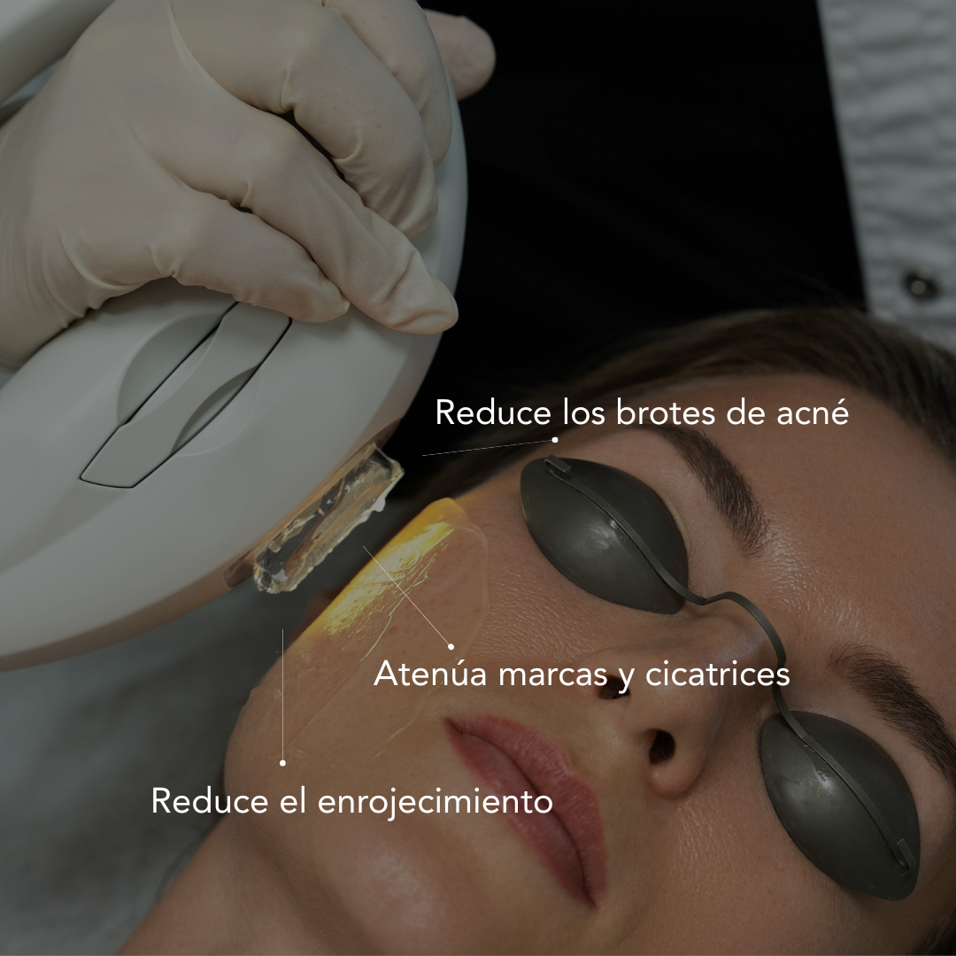 Traitement anti-imperfections par lumière pulsée intense (IPL)