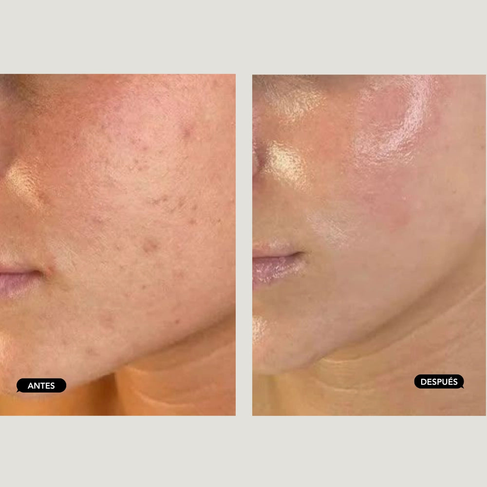 Traitement anti-imperfections par lumière pulsée intense (IPL)