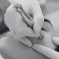 Microdermoabrasión