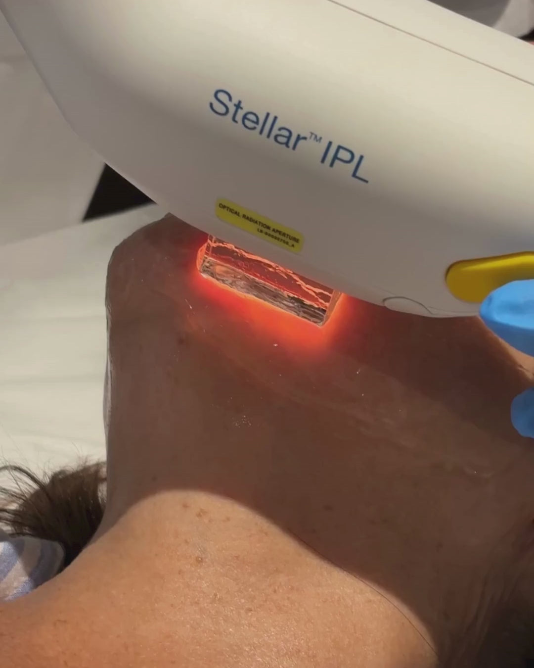 Tratamiento Anti Imperfecciones con IPL